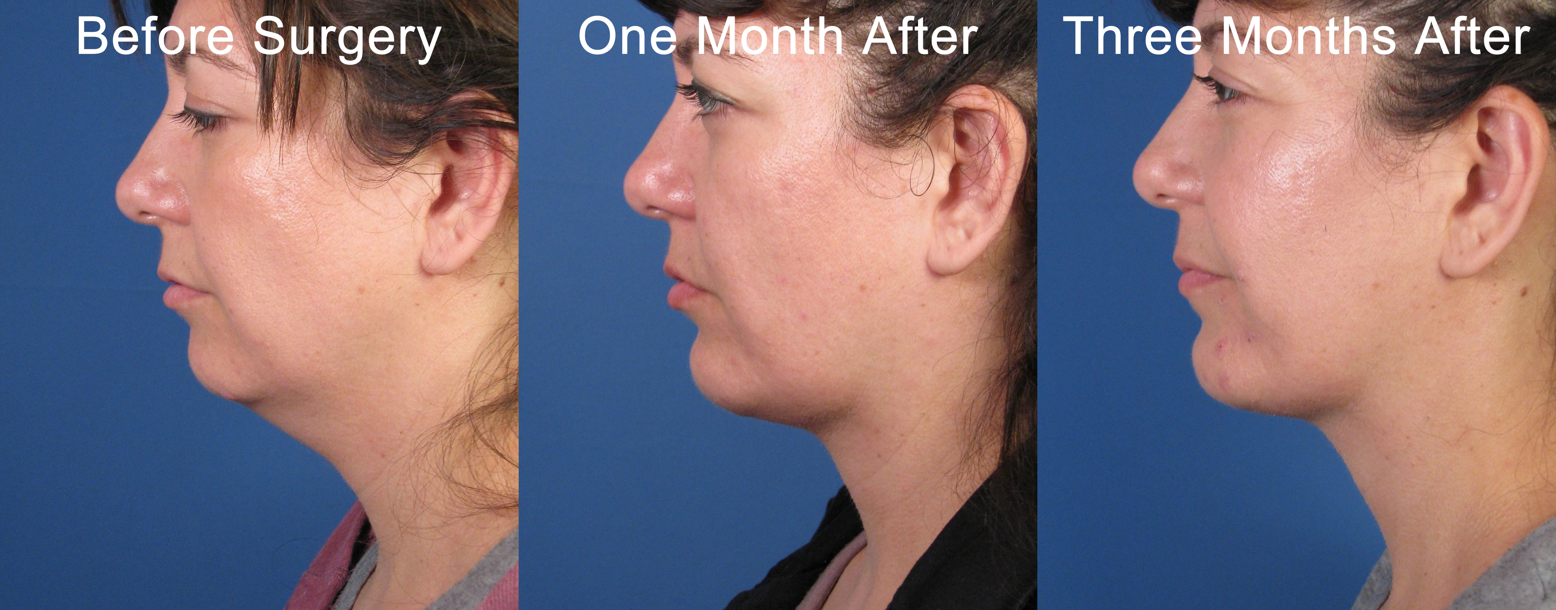 Liposuction double chin recovery, plastic surgery for