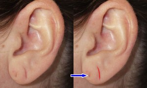 5 Facts About Earlobe Surgery - Restore SD Plastic Surgery
