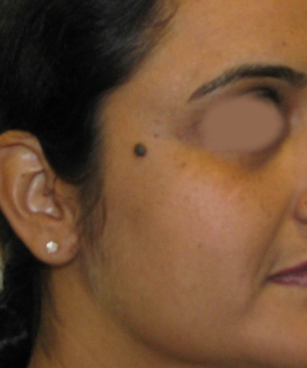Mole Removal By San Diego Facial Plastic Su