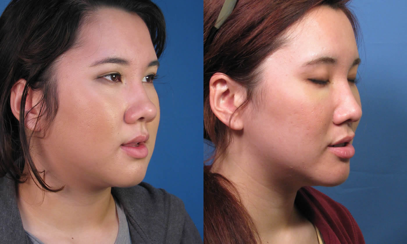 The following Asian rhinoplasty results represent this patient’s nose nearl...