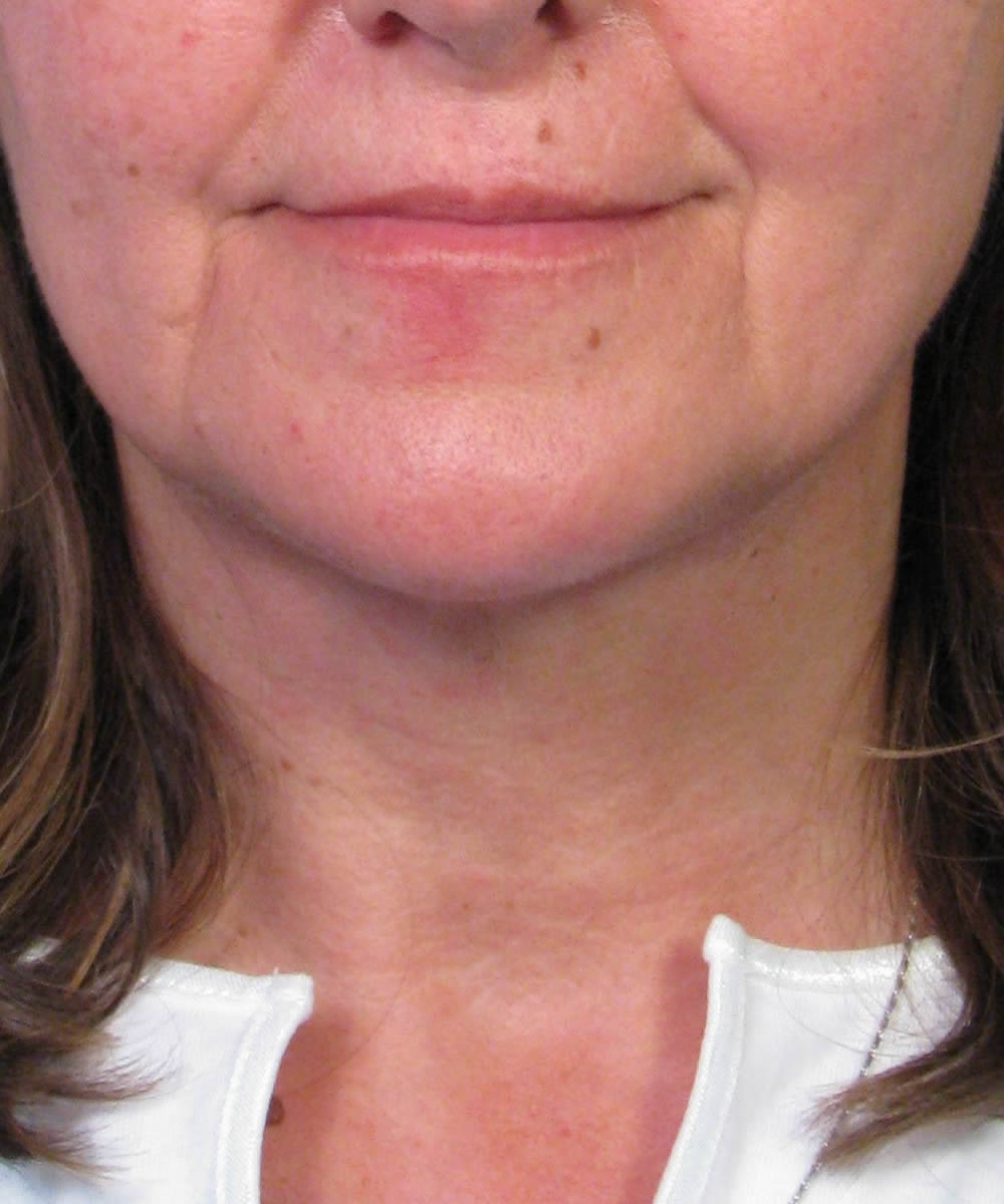 Neck Lift Case Study In San Diego With Liposuction And Platysmaplasty