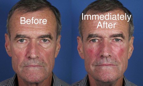 Immediate Effects of Lower Eyelid Restylane Injection