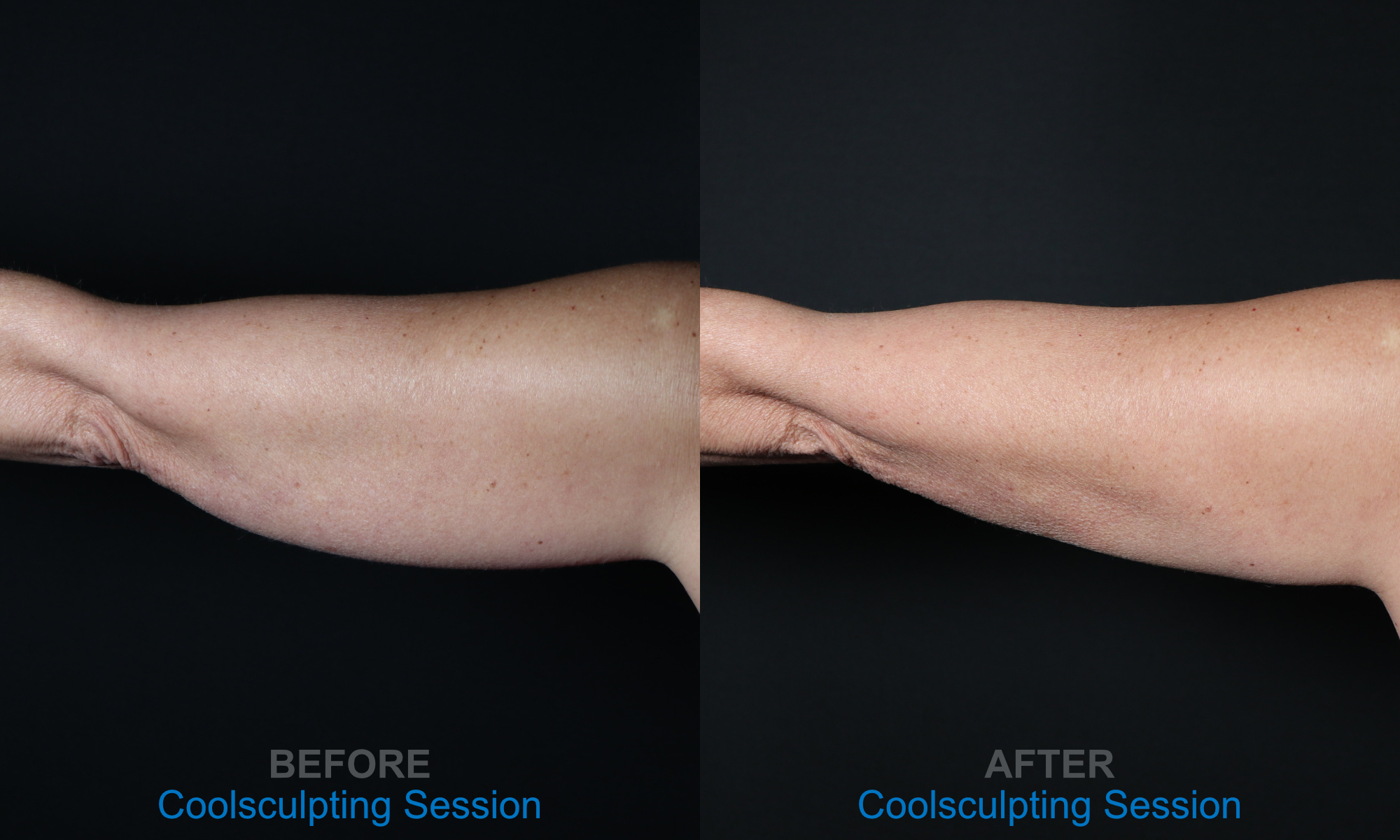 Flabby Arm Treatment with Coolsculpting in La Jolla and San Diego