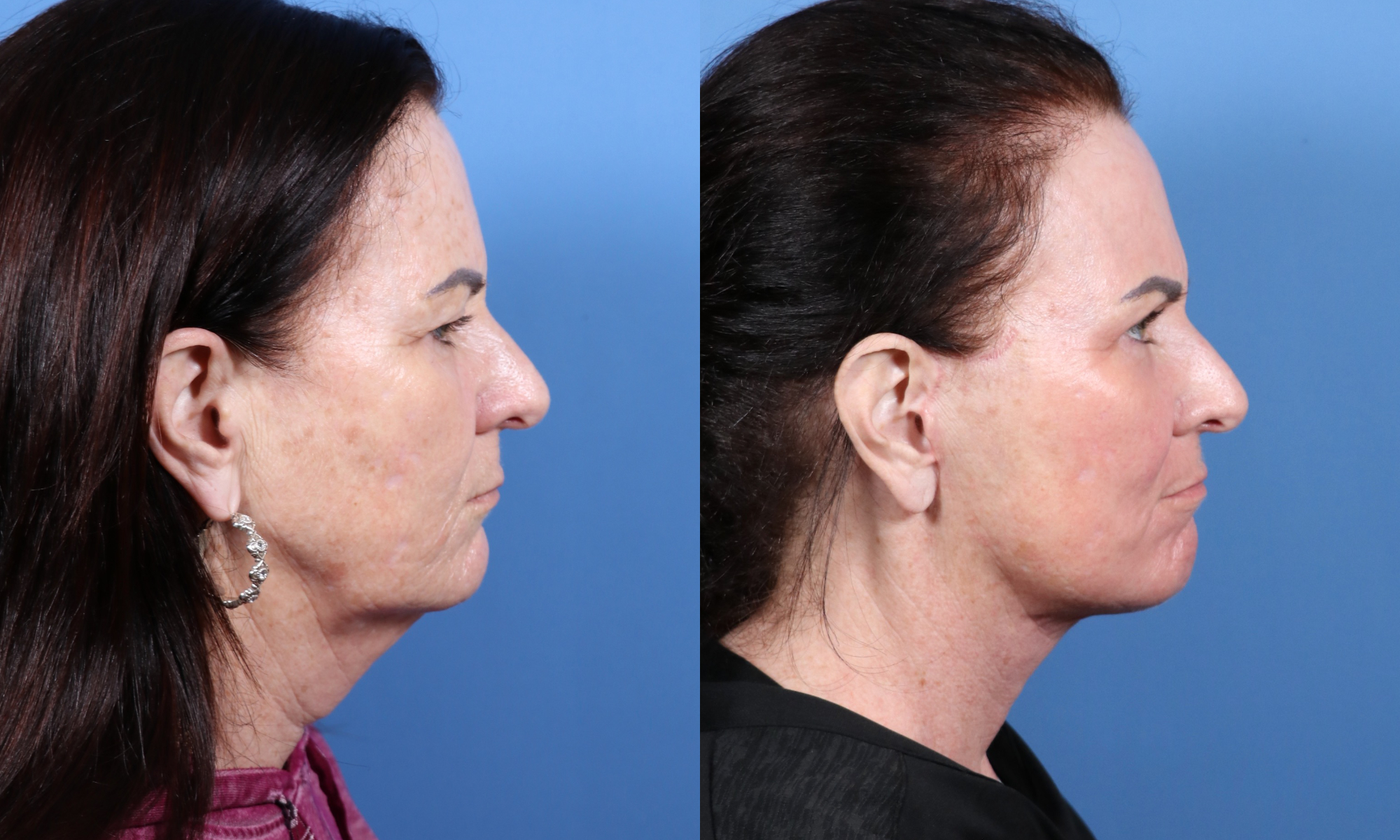 Look 10 Years Younger With Facelift And Necklift Surgery In San Diego