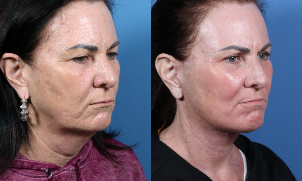 Look 10 Years Younger With Facelift And Necklift Surgery In San Diego