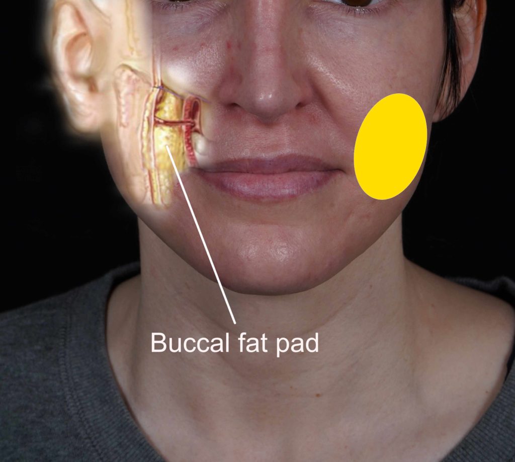 Buccal Fat Removal by San Diego Plastic Surgeon Dr. John Hilinski