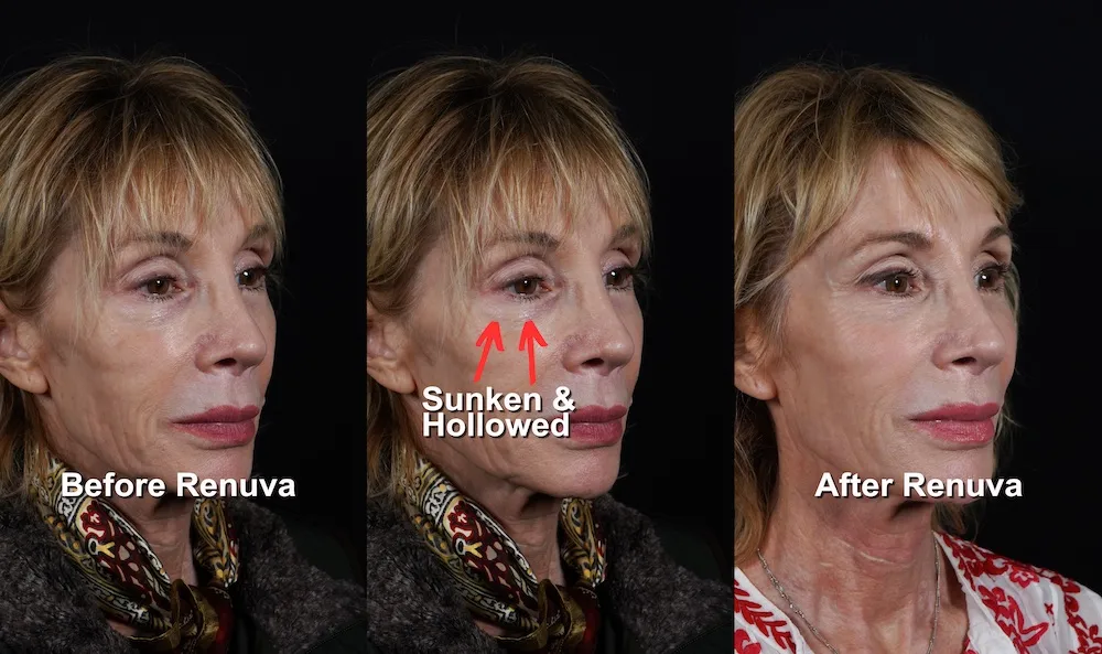 Before and after photos of a woman who got Renuva