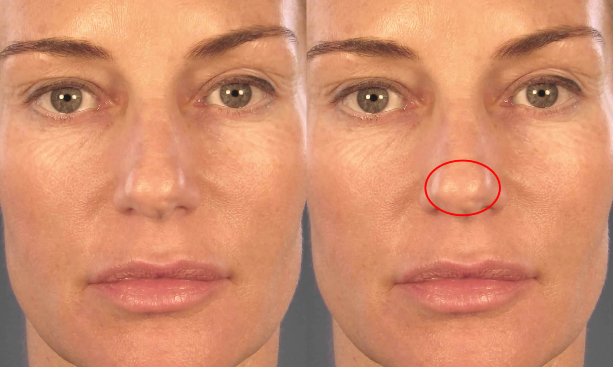 Dr. Hilinski, San Diego’s expert rhinoplasty specialist, discusses