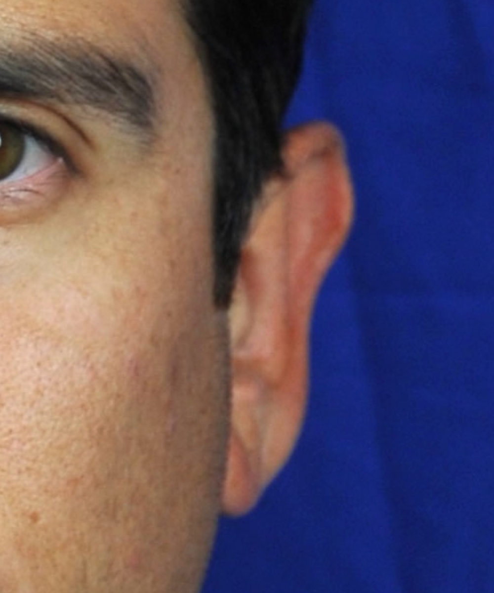FrontalHelicalRimBefore
