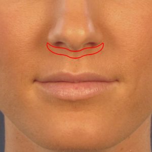 LipLiftIncision