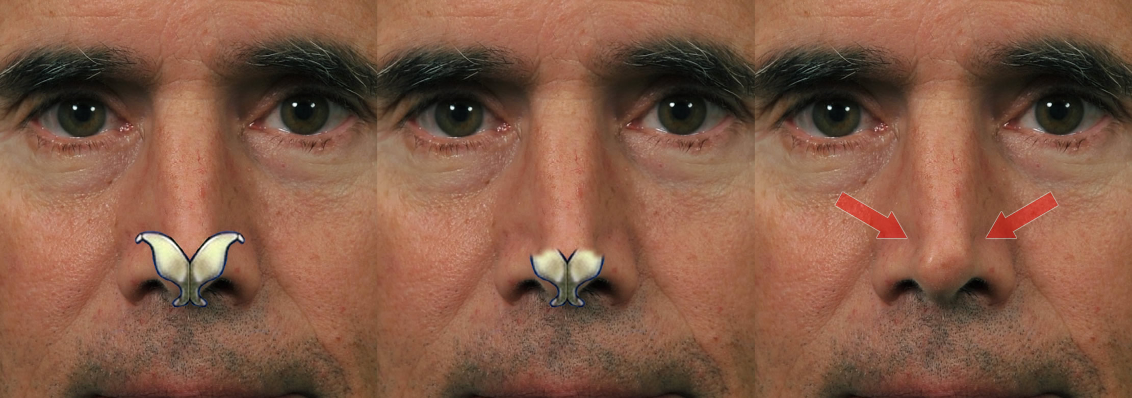 Pinched Nasal Tip Repair Dr. Hilinski