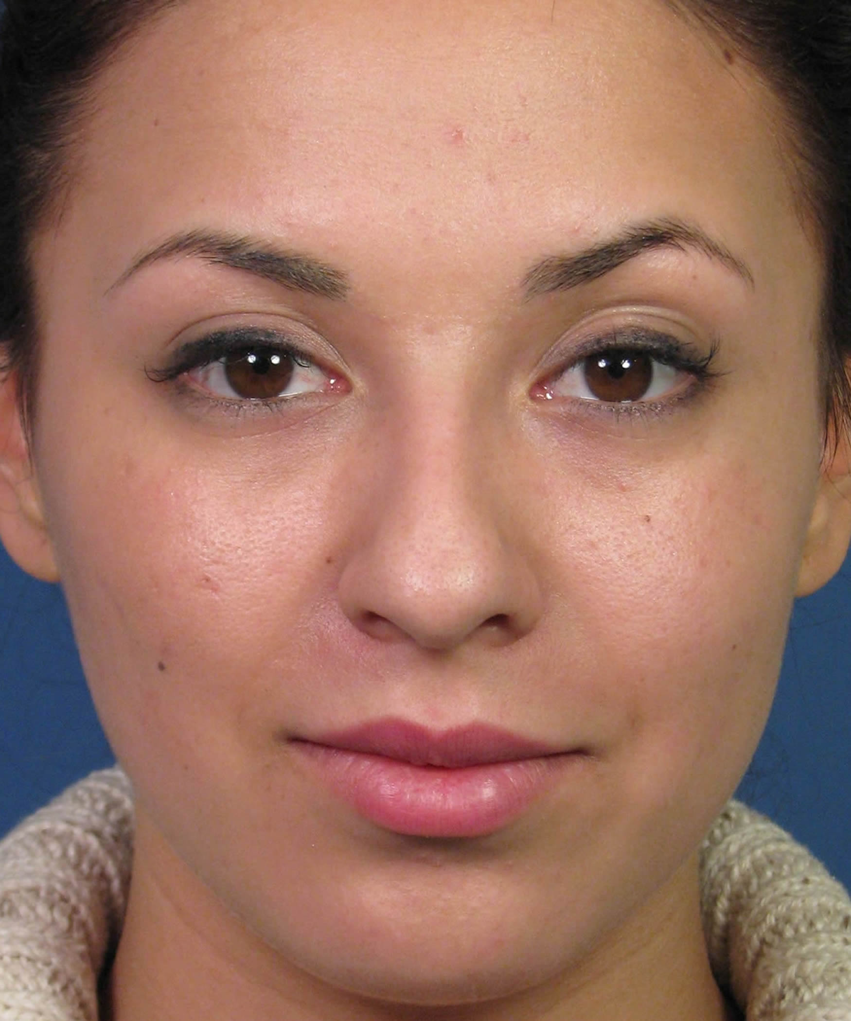 Bulbous Wide Nasal Tip Rhinoplasty Surgery Dr. Hilinski