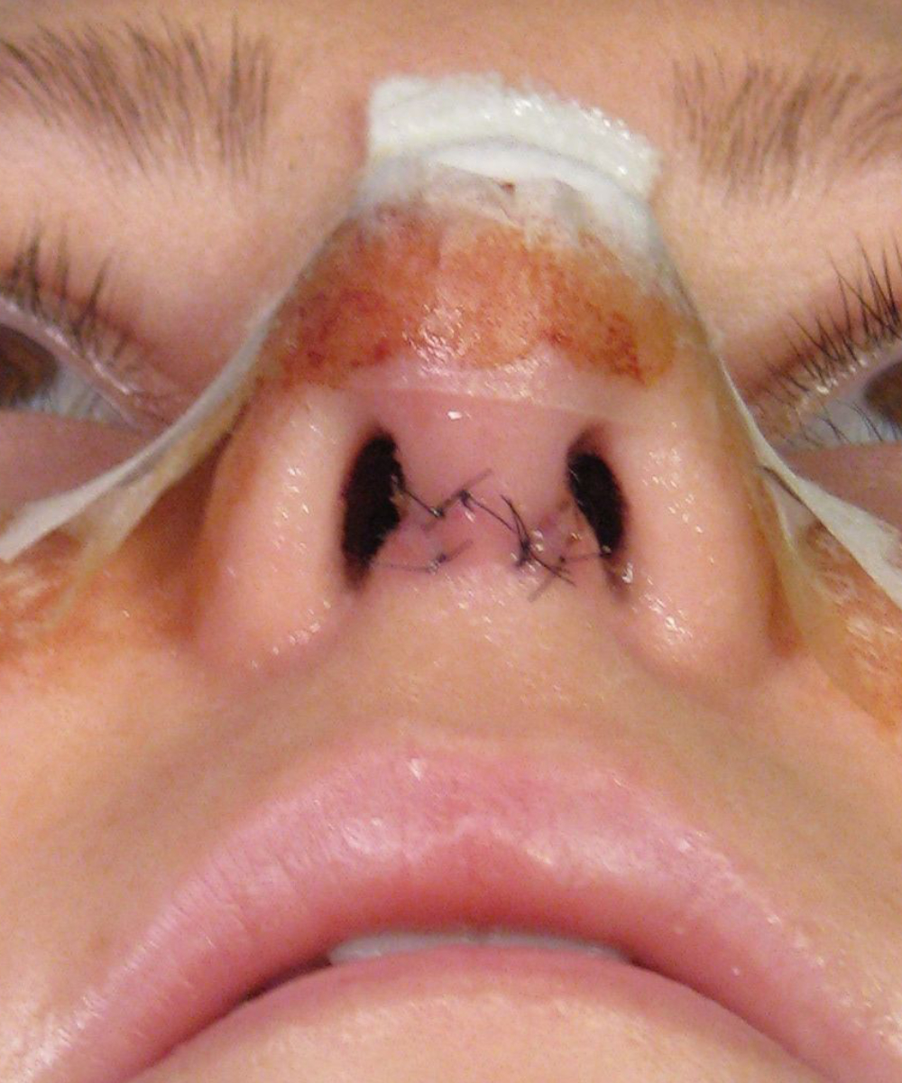 Rhinoplasty Wound Care