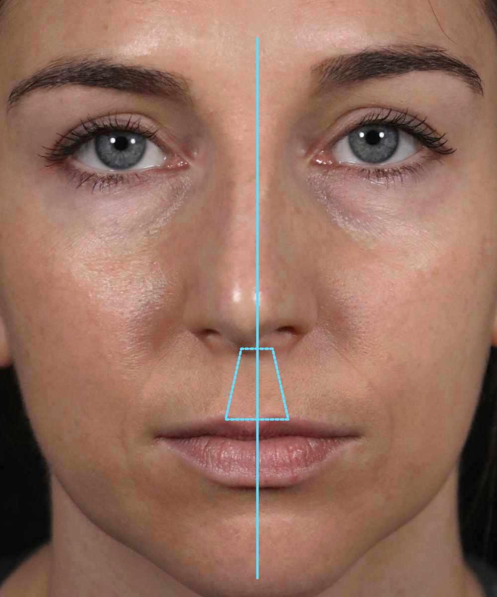 Crooked Nose Correction Dr. Hilinski