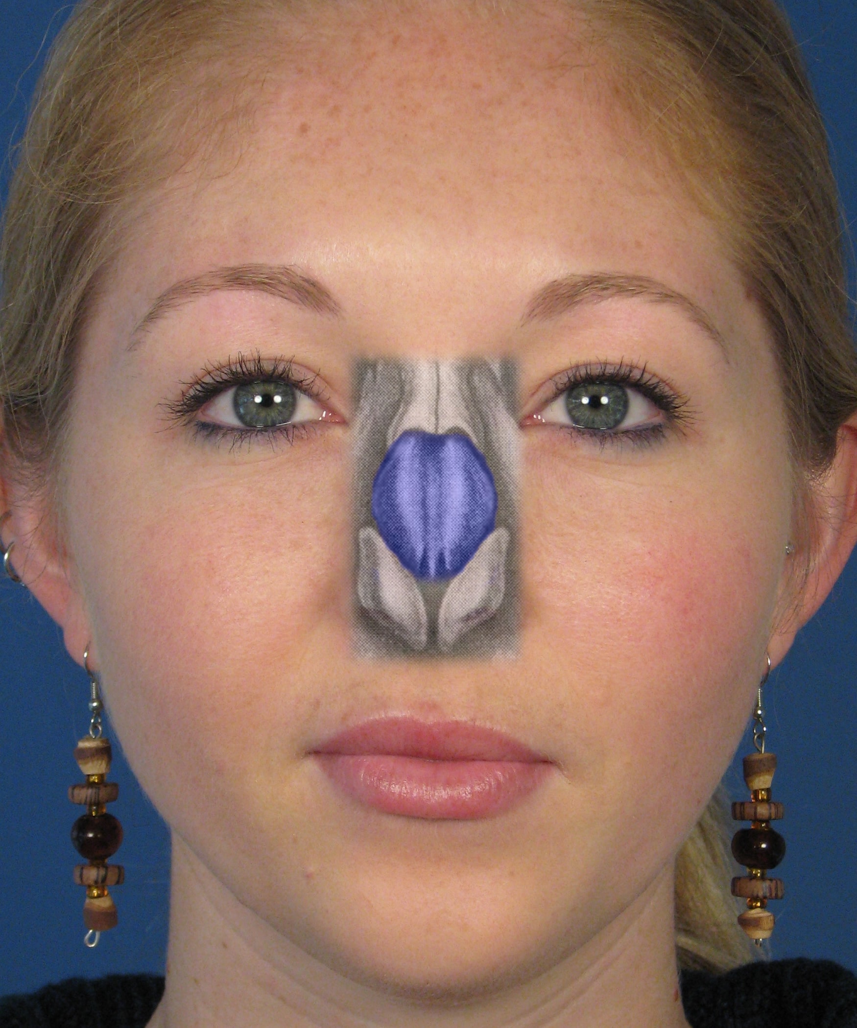 Spreader Grafting in Rhinoplasty San Diego Nose Specialist Dr. Hilinski