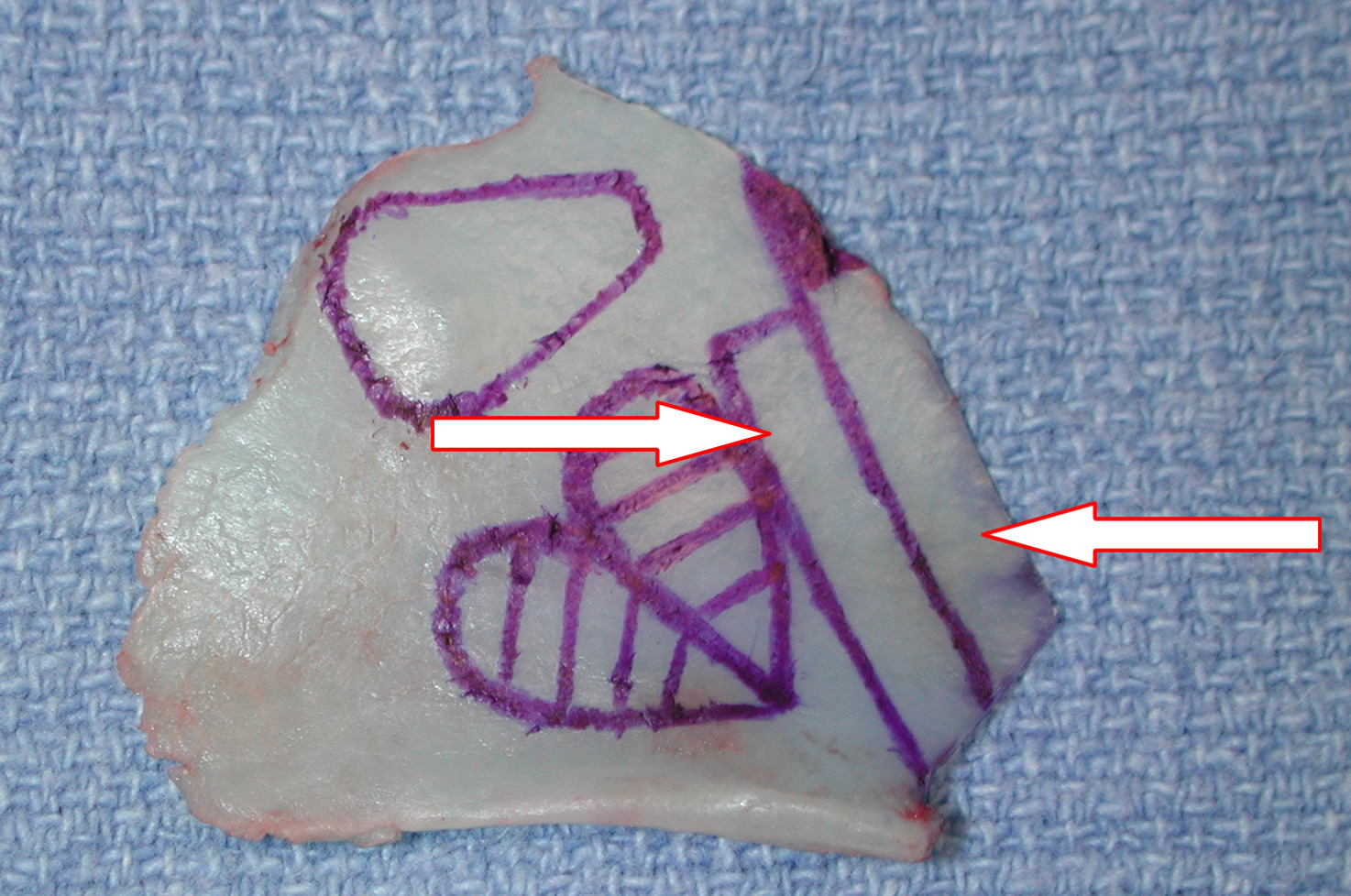 Spreader Grafting in Rhinoplasty San Diego Nose Specialist Dr. Hilinski