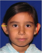 ear surgery, otoplasty, ear pinning