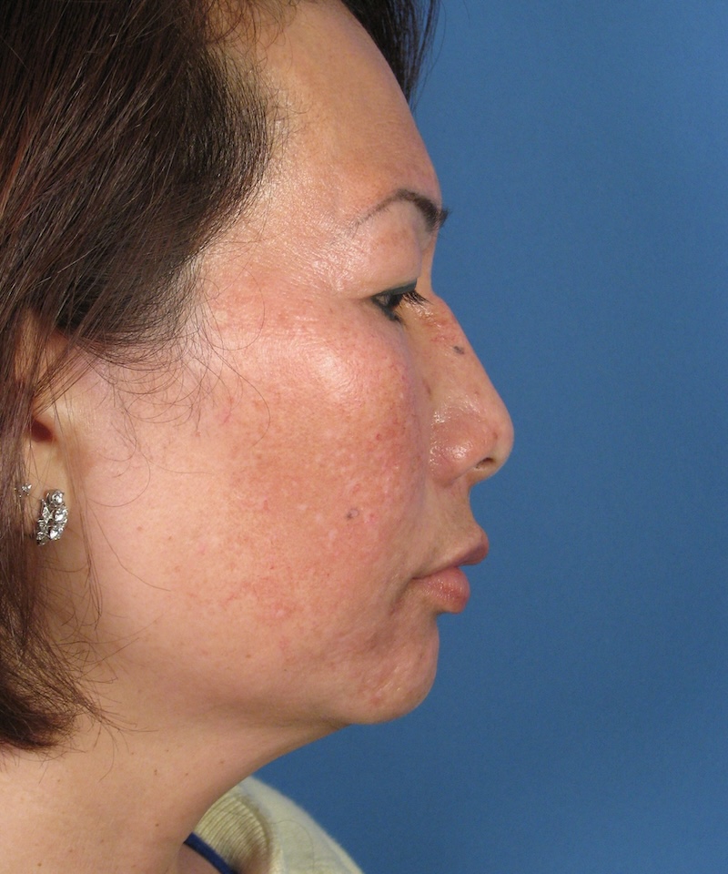 TUTORIALRevRhino82LateralBefore