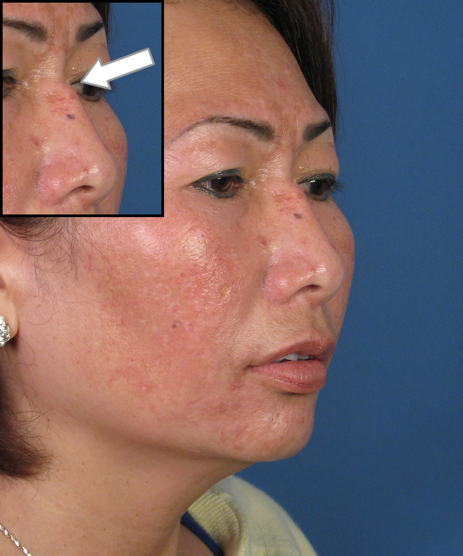 TUTORIALRevRhino82ObliqueBeforeInset