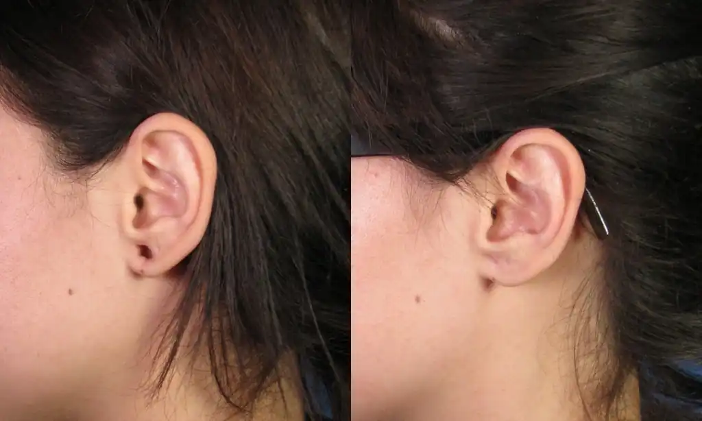 Gauge Torn Earlobe Repair San Diego CA