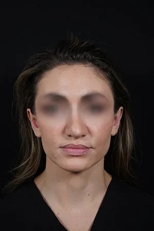 Otoplasty Patient - After