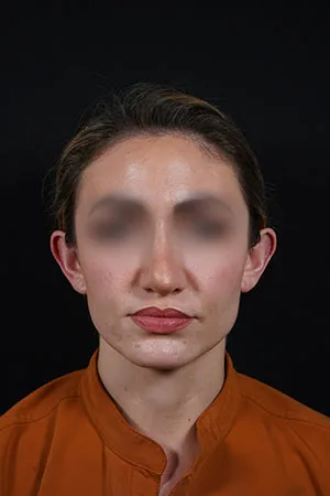 Otoplasty Patient - Before