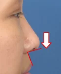 Side view of an Asian female patient's face showing the nose with a red arrow and lines showing the correct nasolabial angle