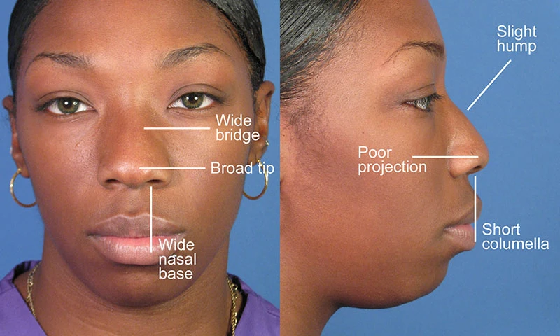 Front and side profile of a person's nose with labels indicating a wide bridge, broad tip, wide nasal base, slight hump, poor projection, and short columella.