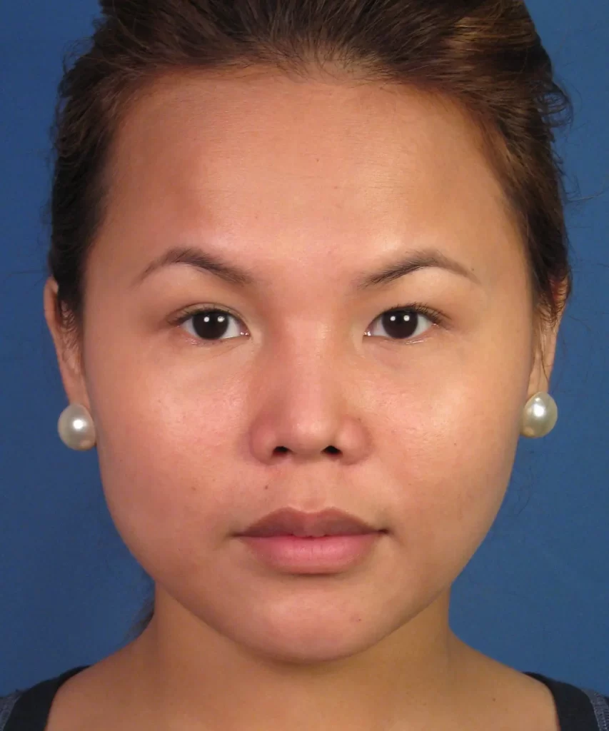 Front view of the face of a female Asian patient after Asian rhinoplasty