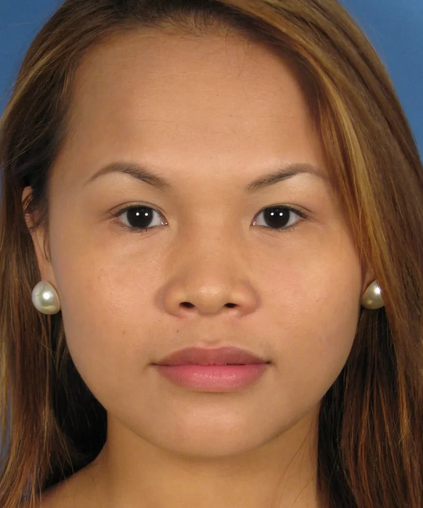 Front view of the face of a female Asian patient before Asian rhinoplasty