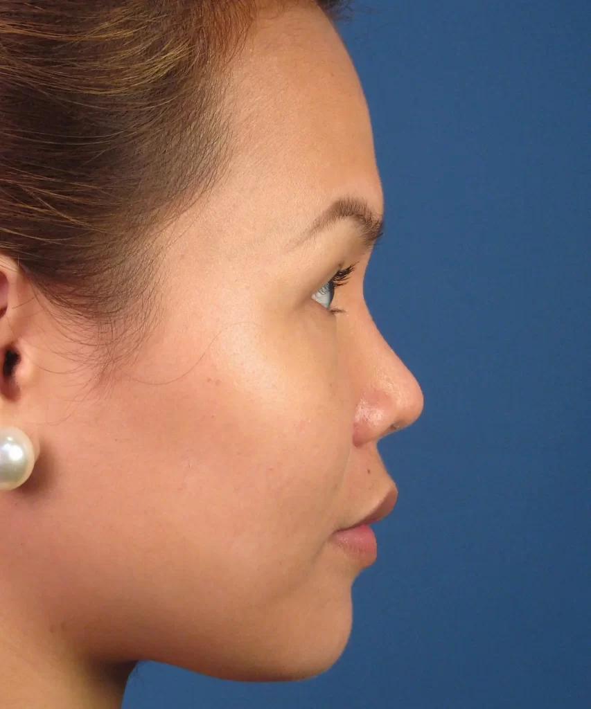 Lateral view of the face of a female Asian patient after Asian rhinoplasty 