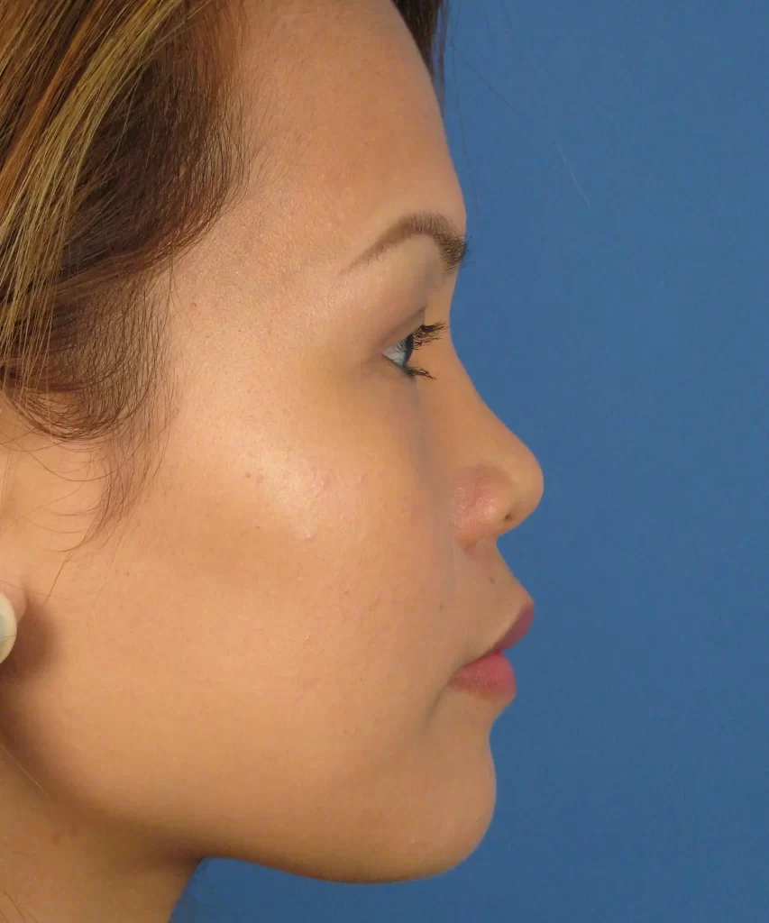 Lateral view of the face of a female Asian patient before Asian rhinoplasty 