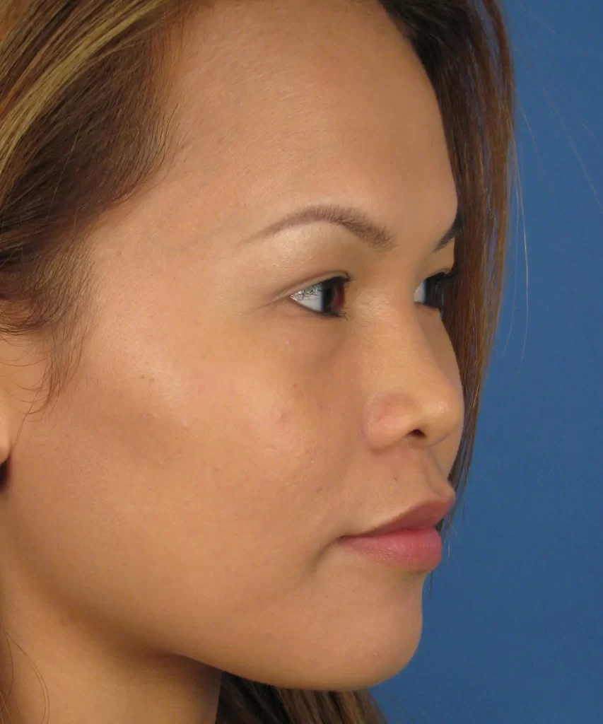 Oblique view of the face of a female Asian patient before Asian rhinoplasty 