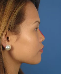 Profile of an Asian woman with a red line indicating the slope of the nose and deficiency in bridge height