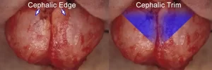 Close-up comparison of two surgical techniques, labeled "Cephalic Edge" on the left and "Cephalic Trim" on the right, highlighting the differences with arrows and blue shading.