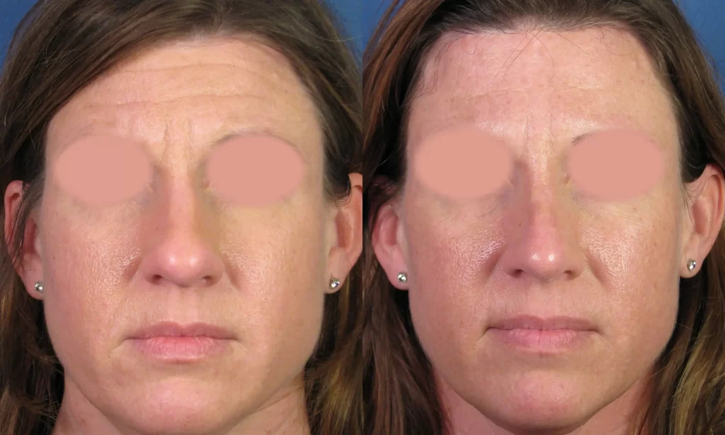 Side-by-side comparison of a woman's face showing different skin textures and tones in each image. Eyes are obscured.
