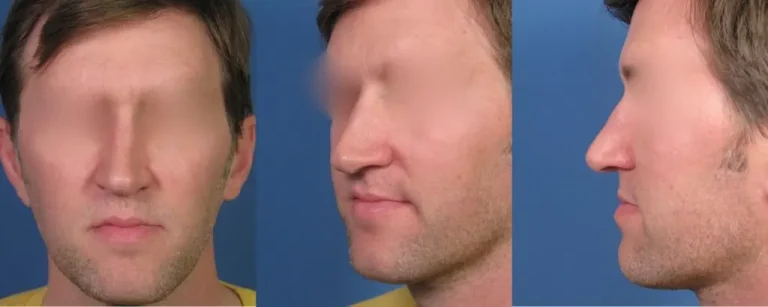 Three side-by-side views of a man's face; front, angled, and side profiles against a blue background. Facial features are blurred.