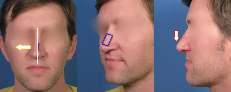 Three side-by-side profile views of a man's face with arrows and lines indicating nose alignment and angles.