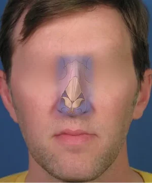 Illustration of a human nose anatomy overlay on a person's face, highlighting nasal structure and sinus cavities.