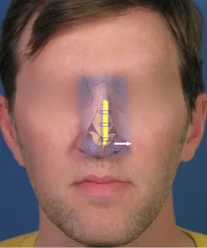 Diagram of a man's face showing nasal airflow with arrows indicating the pathway through the nose.