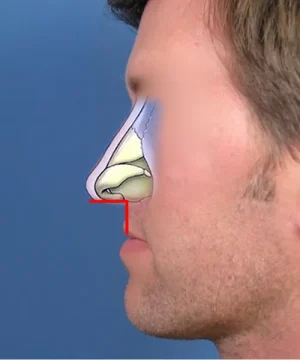 Side view diagram of a human head showing the nasal anatomy in cross-section, with emphasis on the nasal cavity and surrounding structures, against a blue background.