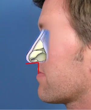 Profile view of a person's face with a diagram overlay showing the internal structure of the nose, highlighting the nasal cavity and passageways against a blue background.
