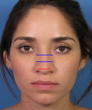 Front view of a woman's face with blue lines on her nose bridge and a red line on her nose tip against a blue background.