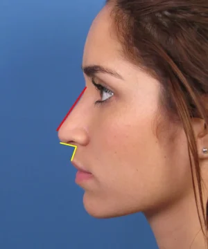 Profile view of a woman with highlighted angles on her nose, illustrating nose shape analysis against a blue background.