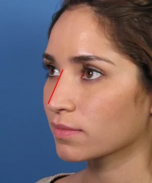 A woman in profile with a red line drawn from her forehead across her nose, against a blue background.