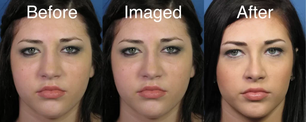 Three side-by-side images of a woman's face, labeled "Before," "Imaged," and "After," showing changes in appearance.