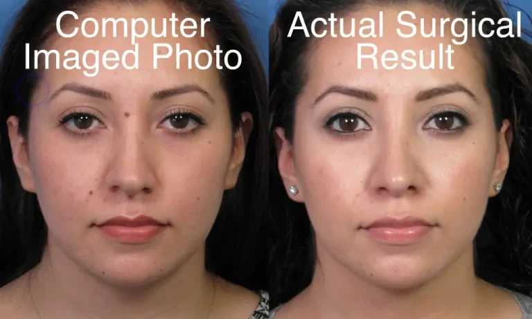 Side-by-side comparison of a computer-imaged photo on the left and the actual surgical result on the right, showing subtle differences in facial features.
