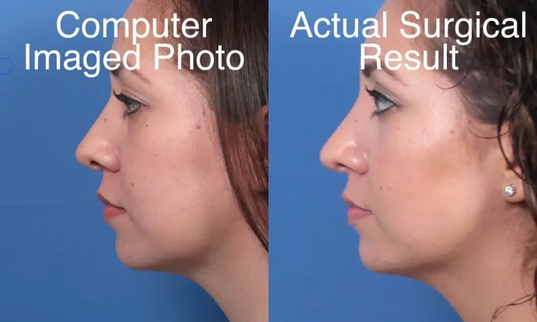 Side-by-side comparison shows a computer-imaged photo on the left and an actual surgical result on the right, featuring a woman's profile against a blue background.