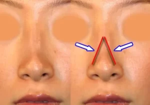 Side-by-side images of a nose, with arrows and lines illustrating angles and structure.