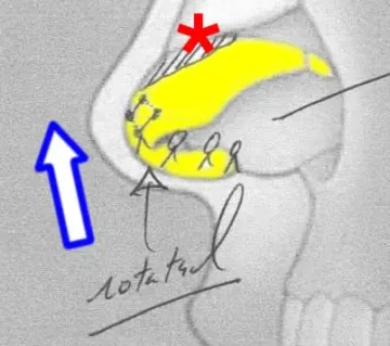 Diagram of a nasal anatomy illustration with a yellow highlighted area, blue arrow, and red asterisk marking specific features. Handwritten notes are present.
